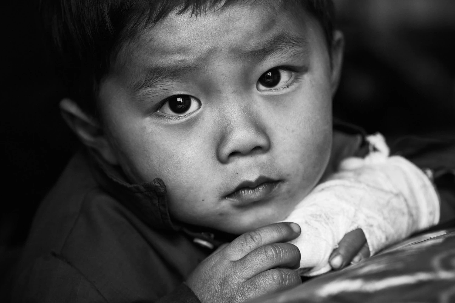 Boy after surgery in Vietnam